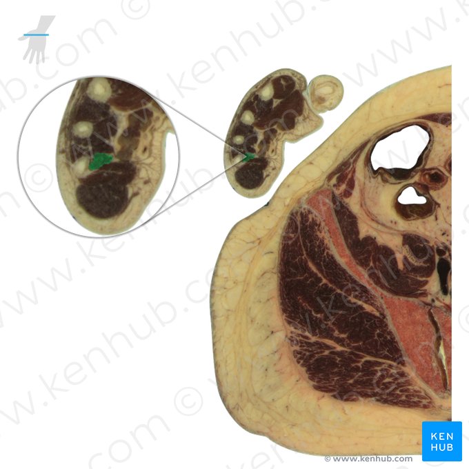 3.º músculo interósseo palmar (Musculus interosseus palmaris 3); Imagem: National Library of Medicine