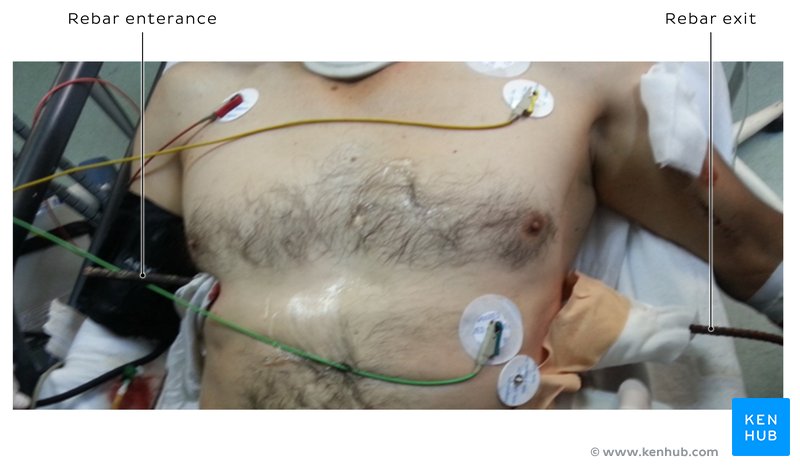 Thoracic penetration trauma injury