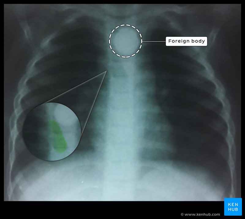 Chest X-Ray - Trachea Compression & Shift