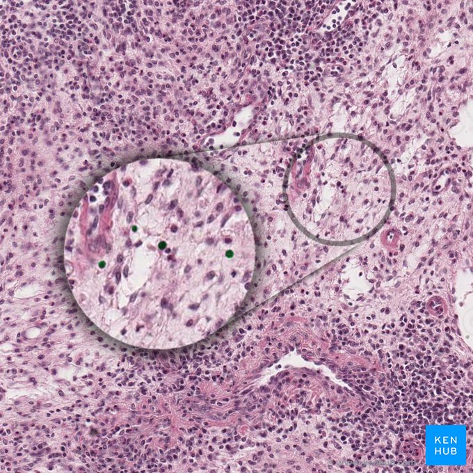 Núcleo de la célula reticular; Imagen: 