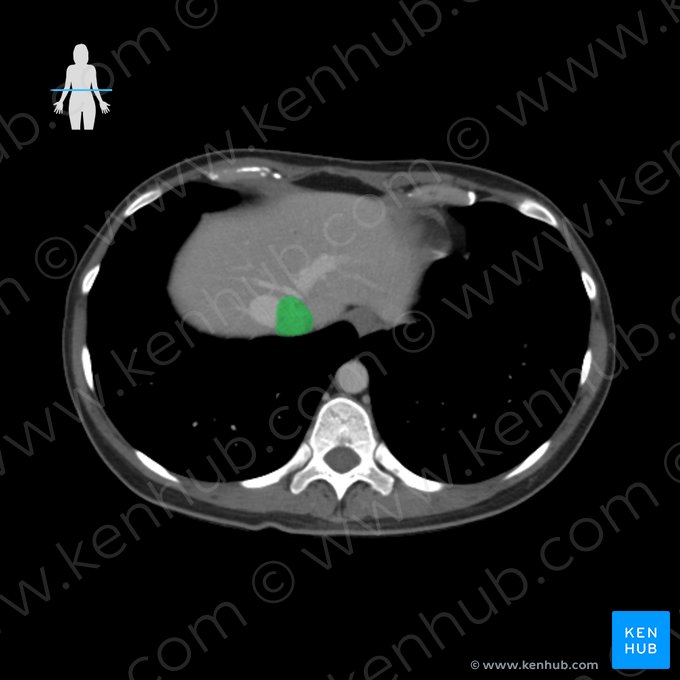 Vena cava inferior (Untere Hohlvene); Bild: 