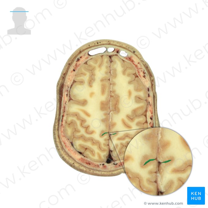 Sulco marginal (Sulcus marginalis); Imagem: National Library of Medicine