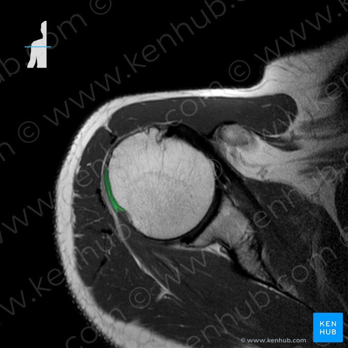 Tendo musculi teretis minoris (Sehne des kleinen Rundmuskels); Bild: 