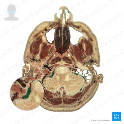 Sigmoid sinus (Sinus sigmoideus); Image: National Library of Medicine