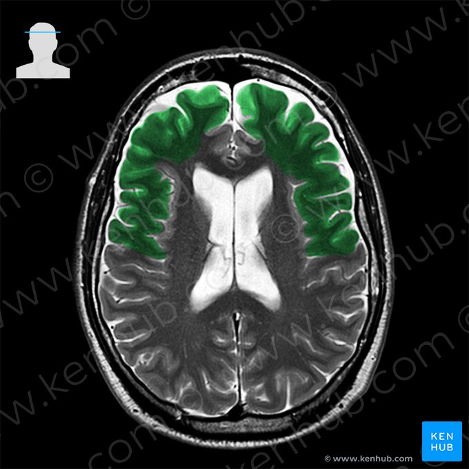 Lobus frontalis (Stirnlappen); Bild: 