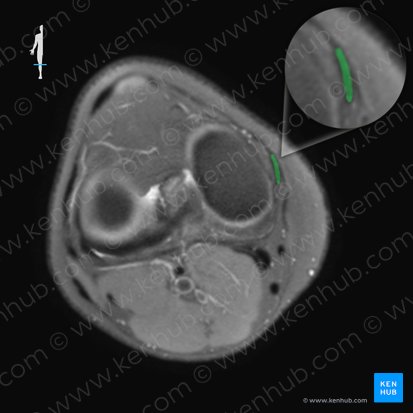 Ligamentum collaterale tibiale genus (Inneres Kollateralband des Kniegelenks); Bild: 