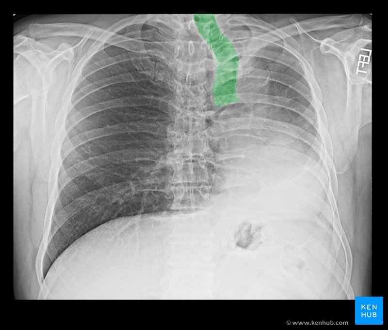 Tracheal and mediastinal shift - Chest X-ray