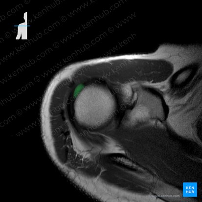 Tendo musculi supraspinati (Sehne des Obergrätenmuskels); Bild: 
