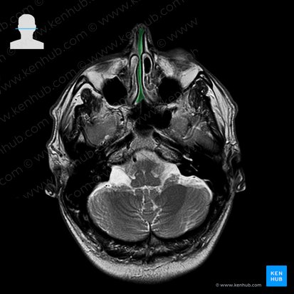 Nasal septum (Septum nasi); Image: 