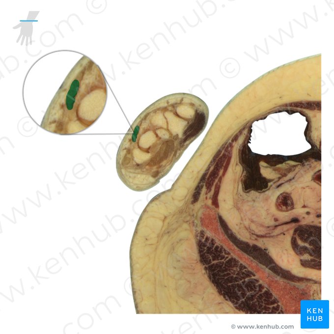 Tendons of extensor digitorum muscle (Tendines musculi extensoris digitorum); Image: National Library of Medicine