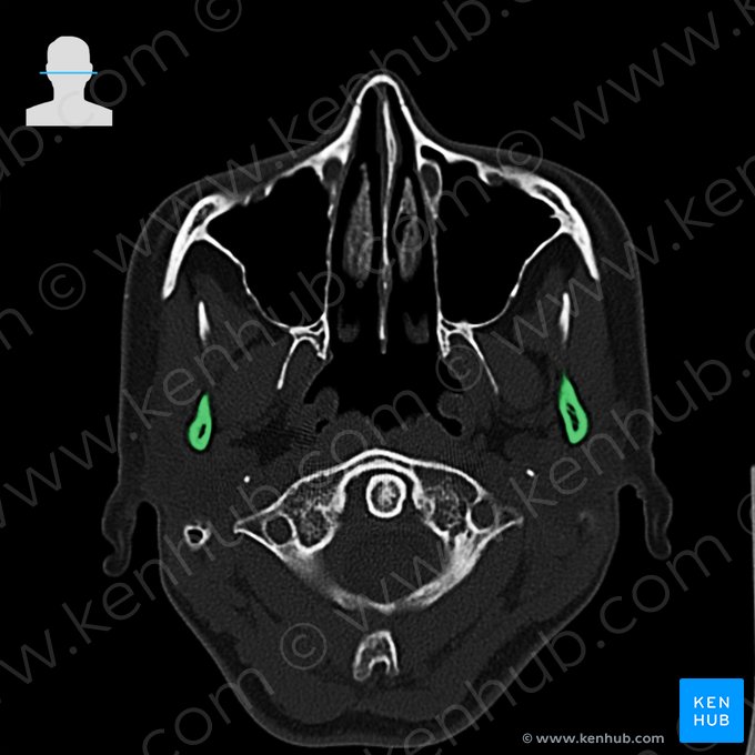 Proceso condilar de la mandíbula (Processus condylaris mandibulae); Imagen: 