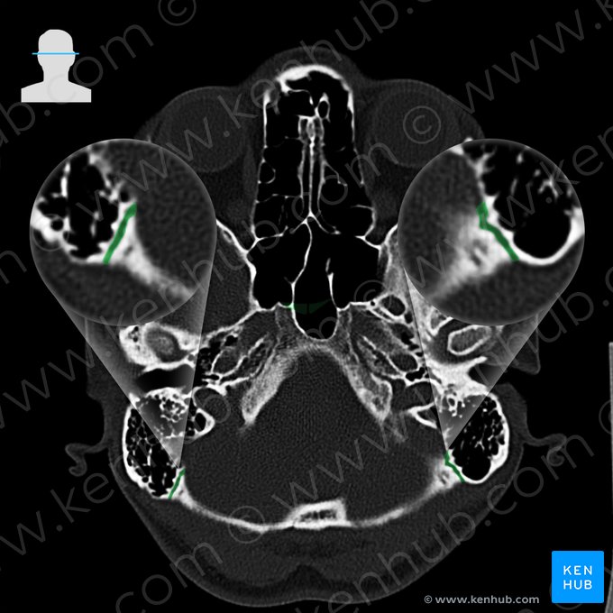 Sutura occipitomastóidea (Sutura occipitomastoidea); Imagem: 