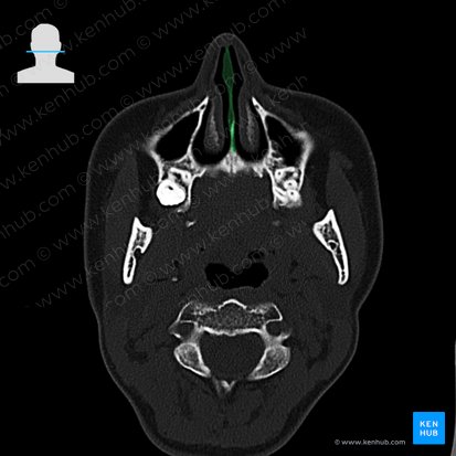 Nasal septum (Septum nasi); Image: 