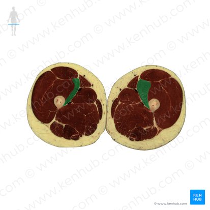 Musculus vastus medialis (Innerer Oberschenkelmuskel); Bild: National Library of Medicine