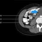 Clinical case: Urachal cyst