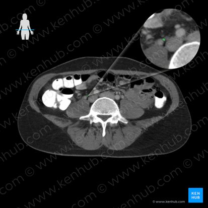 Right ovarian artery (Arteria ovarica dexter); Image: 