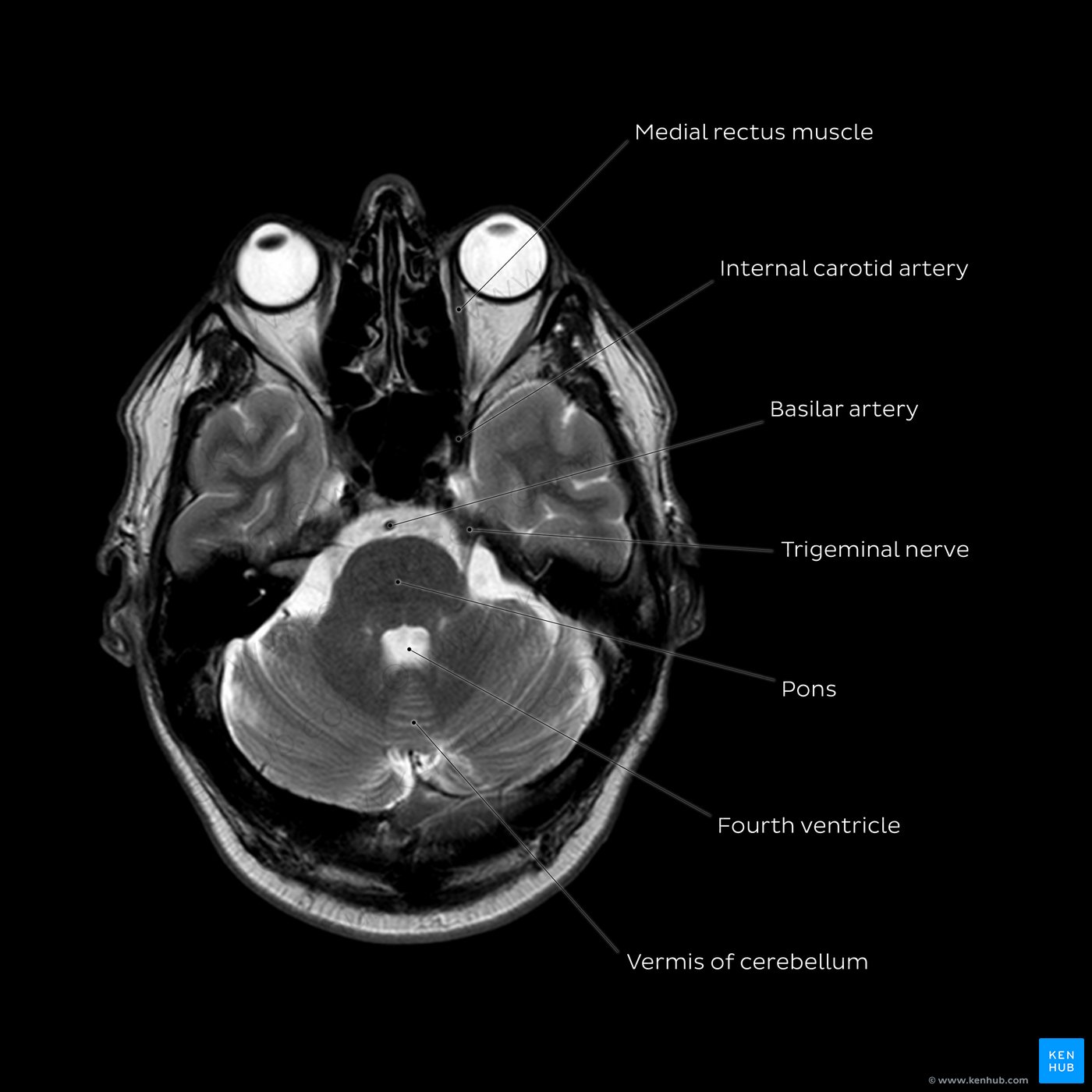 T2 MRI through the lower pons