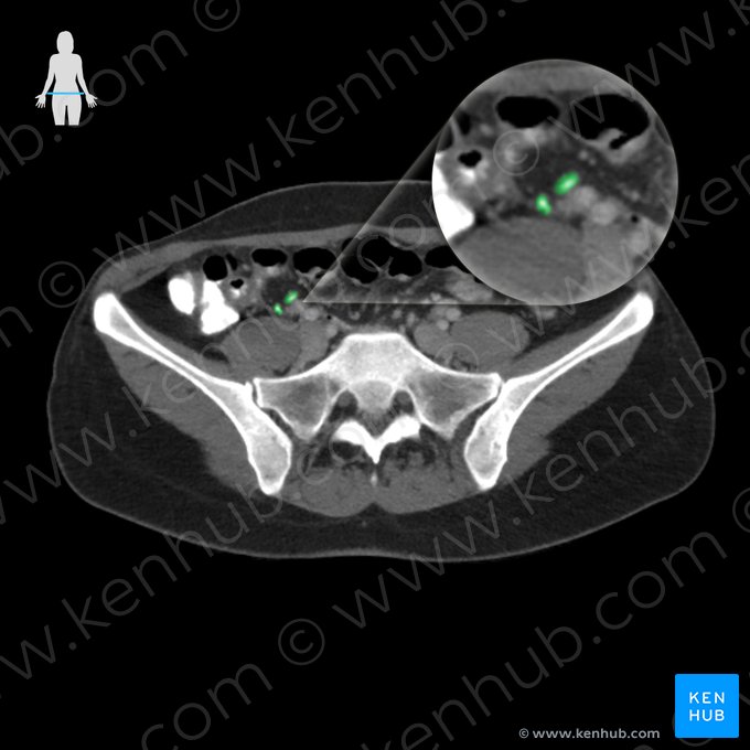 Apéndice vermiforme (Appendix vermiformis); Imagen: 