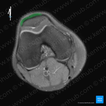 Ligamentum patellae (Kniescheibenband); Bild: 