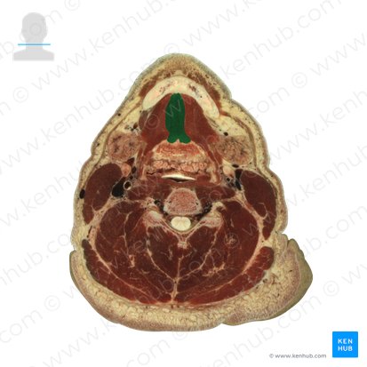 Genioglossus muscle (Musculus genioglossus); Image: National Library of Medicine