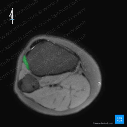 Musculus tibialis anterior (Vorderer Schienbeinmuskel); Bild: 