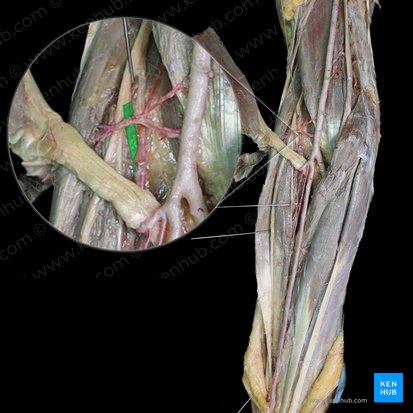 Ramo profundo del nervio radial (Ramus profundus nervi radialis); Imagen: 