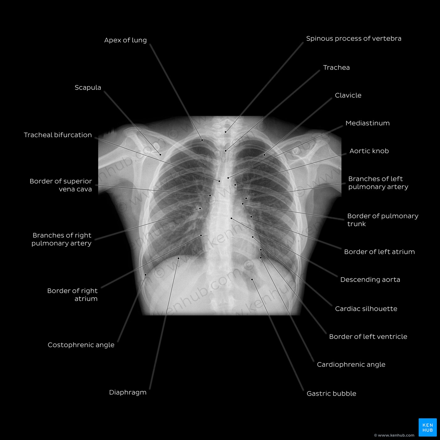 Normal chest x-ray (cxr) an overview diagram: PA projection