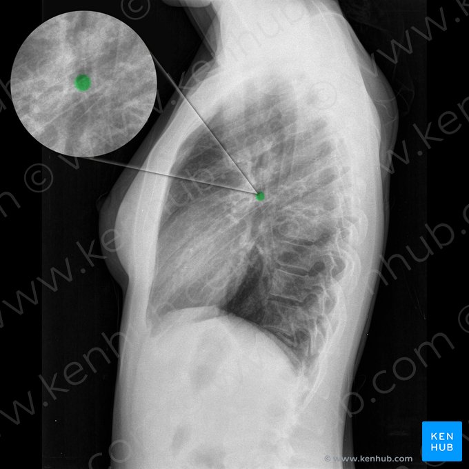 Bronchus principalis dexter (Rechter Hauptbronchus); Bild: 