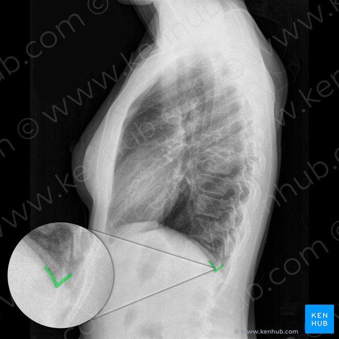 Ângulo costofrênico posterior direito (Angulus costophrenicus posterior dexter); Imagem: 