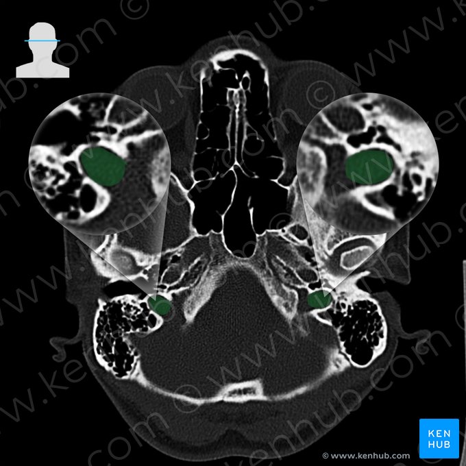 Fossa jugular do osso temporal (Fossa jugularis ossis temporalis); Imagem: 