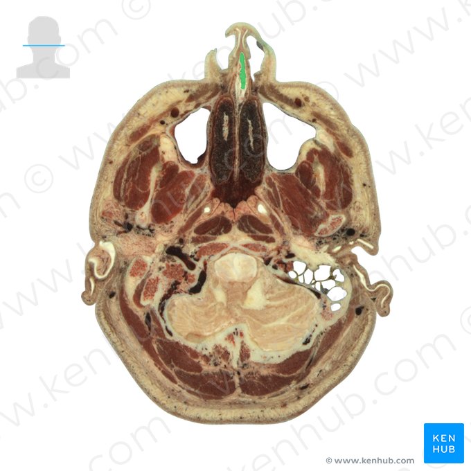 Cartilagem do septo nasal (Cartilago septi nasi); Imagem: National Library of Medicine