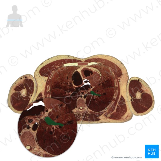 Left pulmonary veins (Venae pulmonales sinistrae); Image: National Library of Medicine