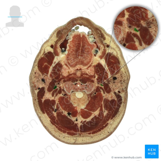 Veia jugular interna (Vena jugularis interna); Imagem: National Library of Medicine