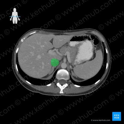 Vena cava inferior (Untere Hohlvene); Bild: 