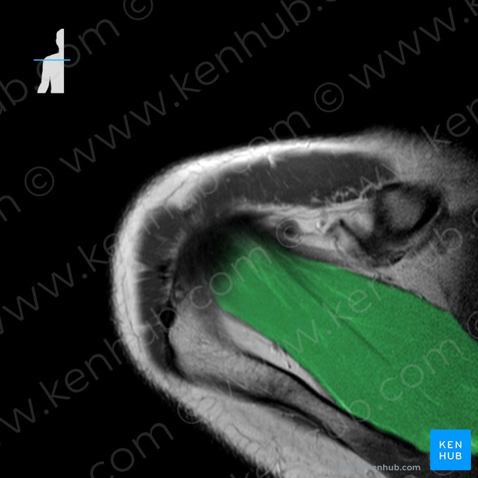 Supraspinatus muscle (Musculus supraspinatus); Image: 