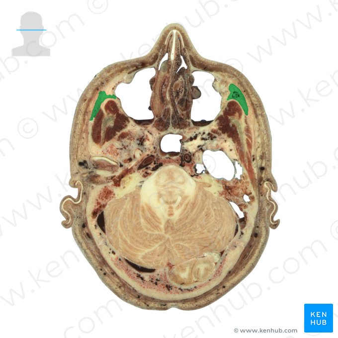 Os zygomaticum (Jochbein); Bild: National Library of Medicine