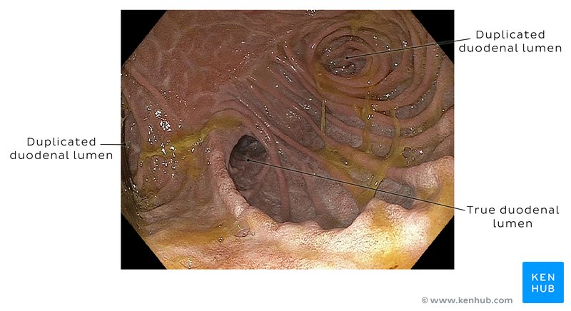 Upper GI tract endoscopy