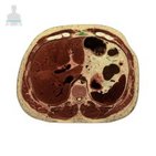 Xiphoid process of sternum