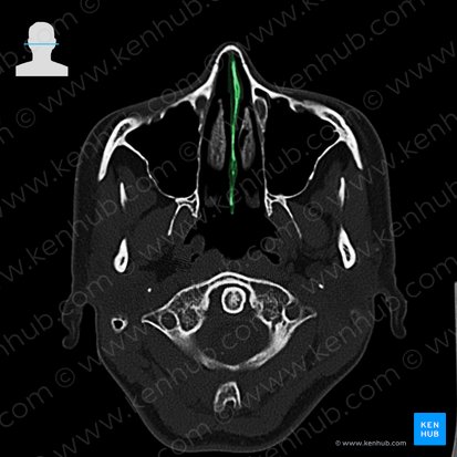 Septo nasal (Septum nasi); Imagem: 