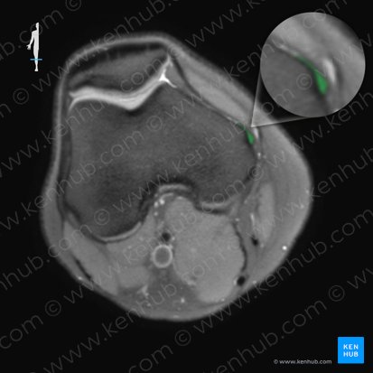 Ligamentum collaterale tibiale genus (Inneres Kollateralband des Knies); Bild: 