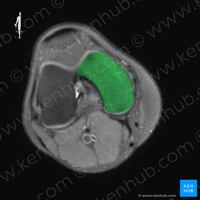 Côndilo medial do fêmur (Condylus medialis ossis femoris); Imagem: 