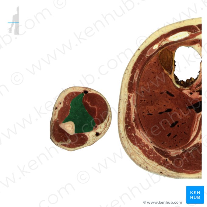 Músculo braquial (Musculus brachialis); Imagem: National Library of Medicine