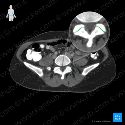 Articulaciones cigapofisarias (Articulatio zygapophysialis); Imagen: 