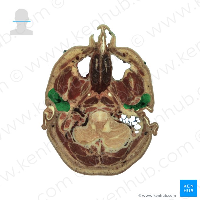 Parotid gland (Glandula parotidea); Image: National Library of Medicine