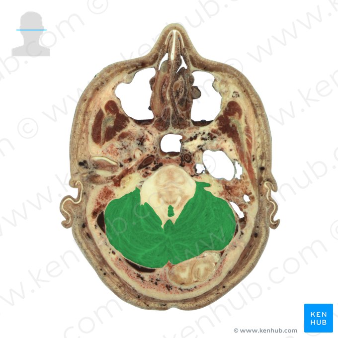 Cerebellum (Kleinhirn); Bild: National Library of Medicine