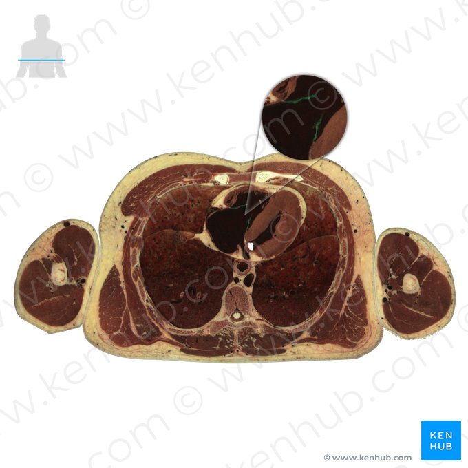 Right atrioventricular valve (Valva atrioventricularis dextra); Image: National Library of Medicine