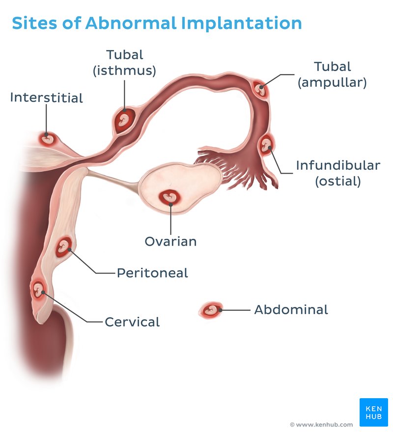 Sites of abnormal implantation