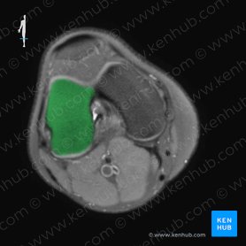 Cóndilo lateral del fémur (Condylus lateralis femoris); Imagen: 
