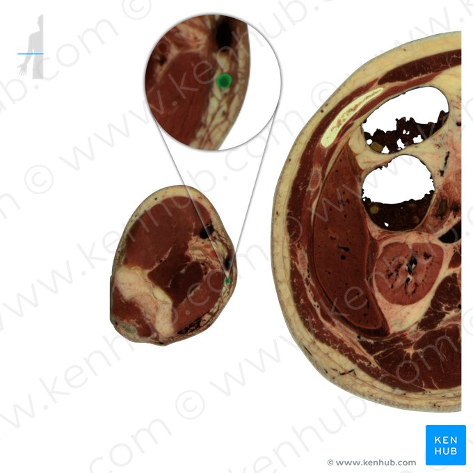 Basilic vein (Vena basilica); Image: National Library of Medicine