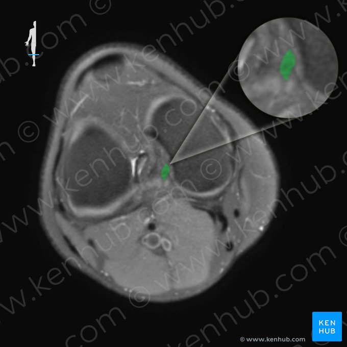Ligamento cruzado posterior (Ligamentum cruciatum posterius); Imagen: 